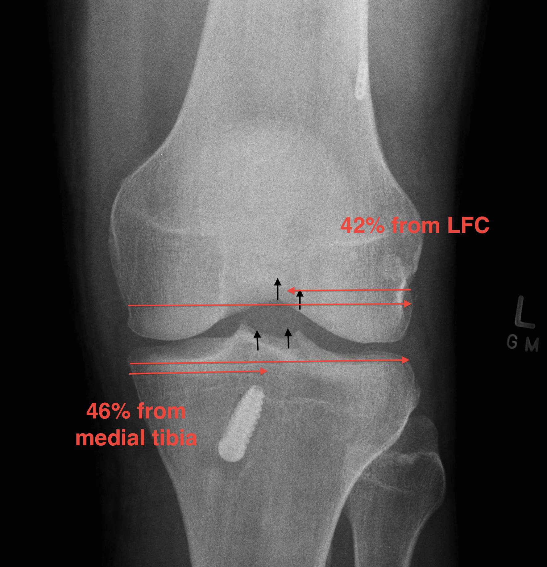 ACL Reconstruction AP Tunnel Measurements